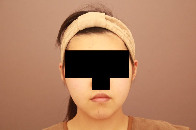 お顔の脂肪吸引で小顔に