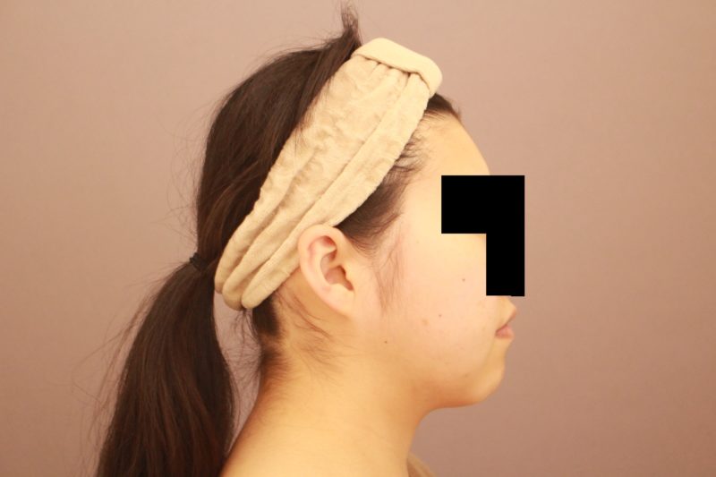 お顔の脂肪吸引について