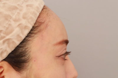 ボァイエのおでこについて