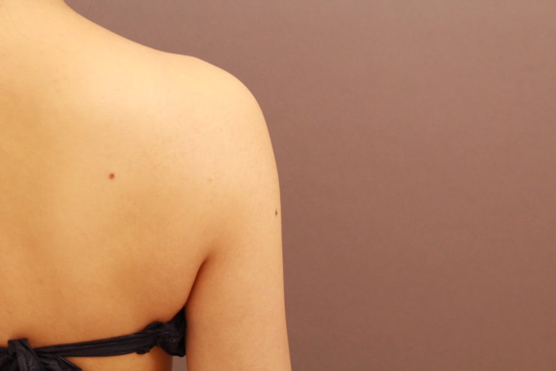 細めの方の二の腕・肩の脂肪吸引