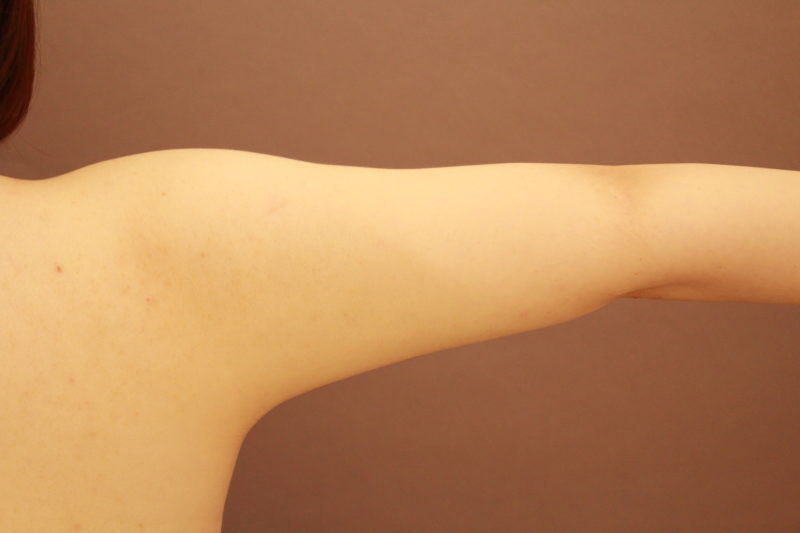 二の腕、肩の脂肪吸引でラインを変えよう!