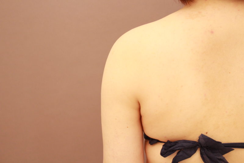 二の腕、肩の脂肪吸引について