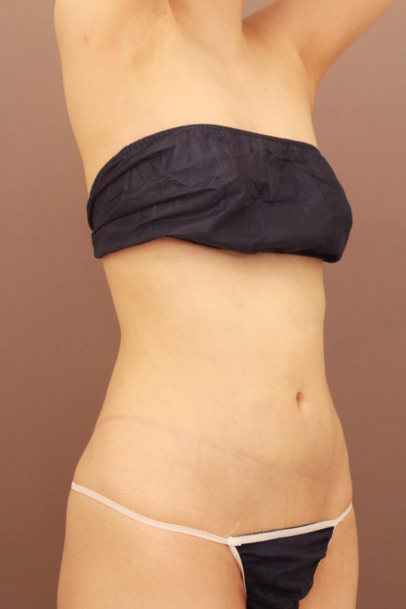 お腹、腰の脂肪吸引