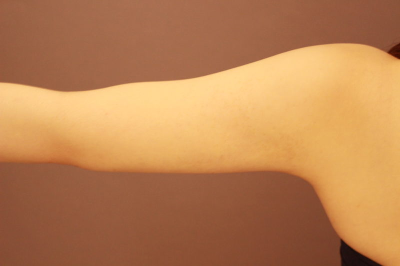 二の腕の脂肪吸引1か月後