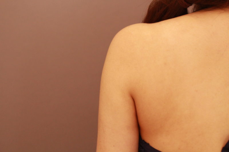 二の腕の脂肪吸引