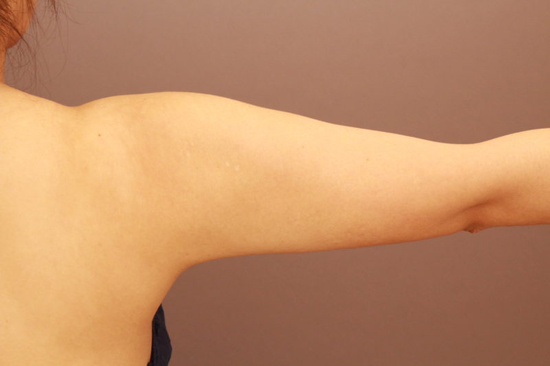 二の腕、肩の脂肪吸引~振りそで~