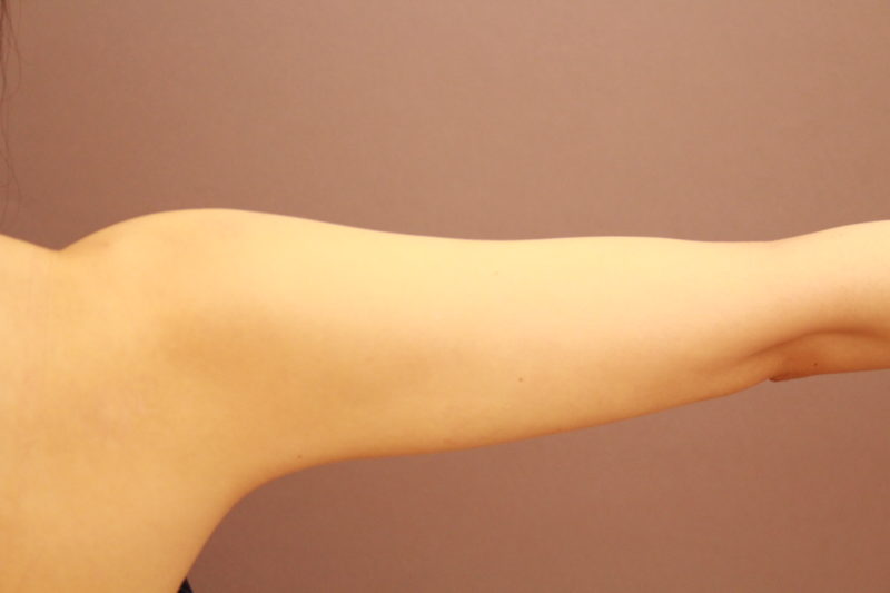 二の腕、肩の脂肪吸引