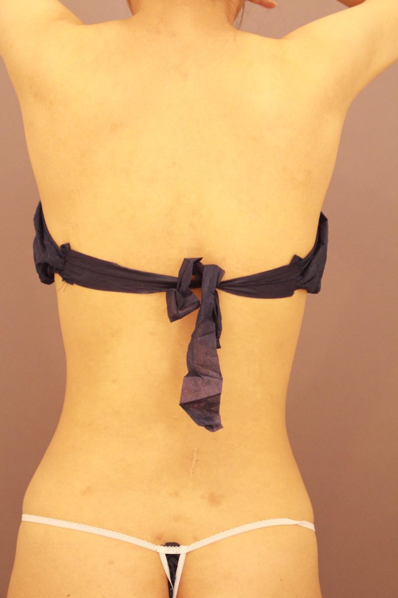 お腹、腰の脂肪吸引