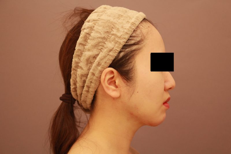 ほほ顎脂肪吸引の翌日の様子