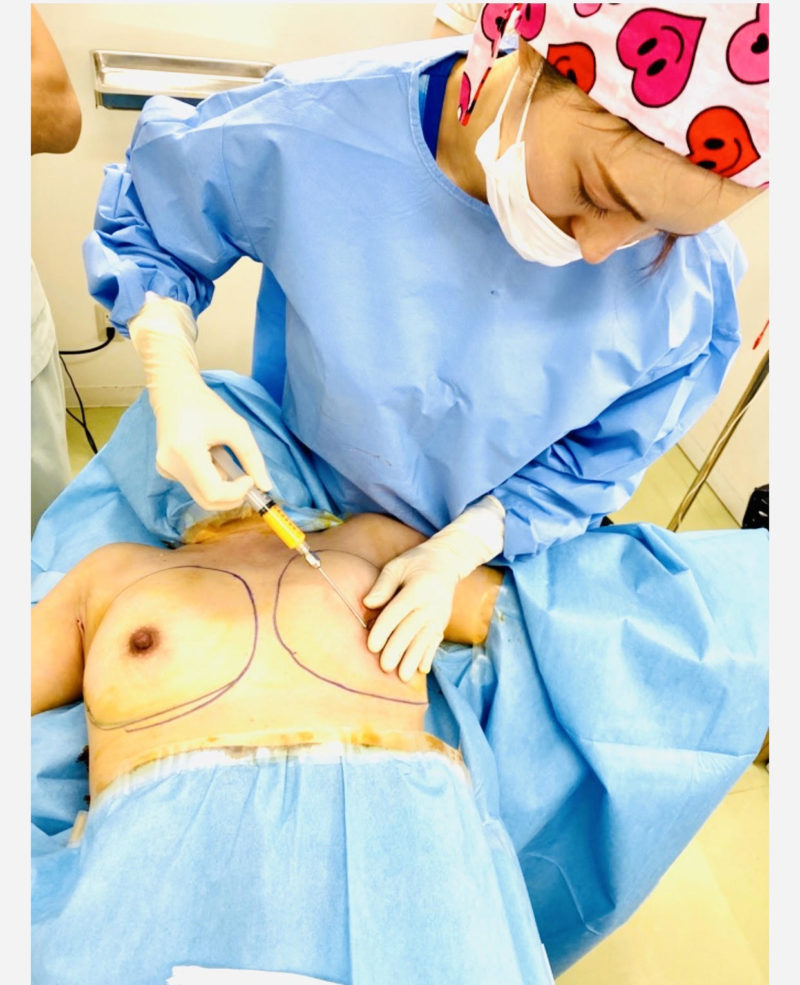 私が大好きな夢の治療「脂肪注入豊胸」について