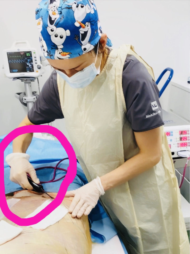 たるみに対する新治療「レヌビオン」