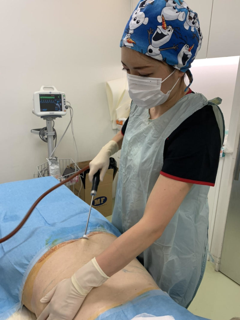 腰の脂肪吸引の傷について