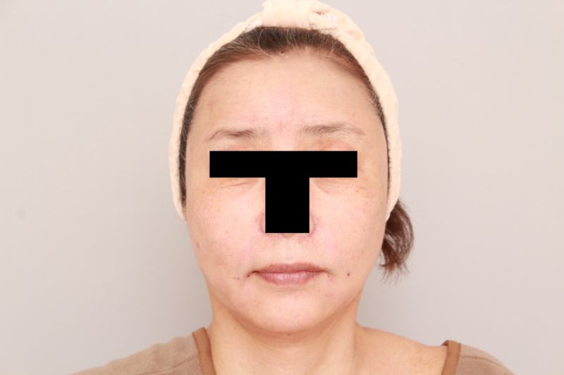 脂肪注入でエイジングケア