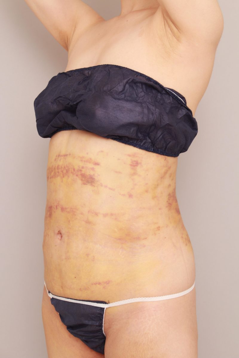 腰、お腹の脂肪吸引の1週間後の様子