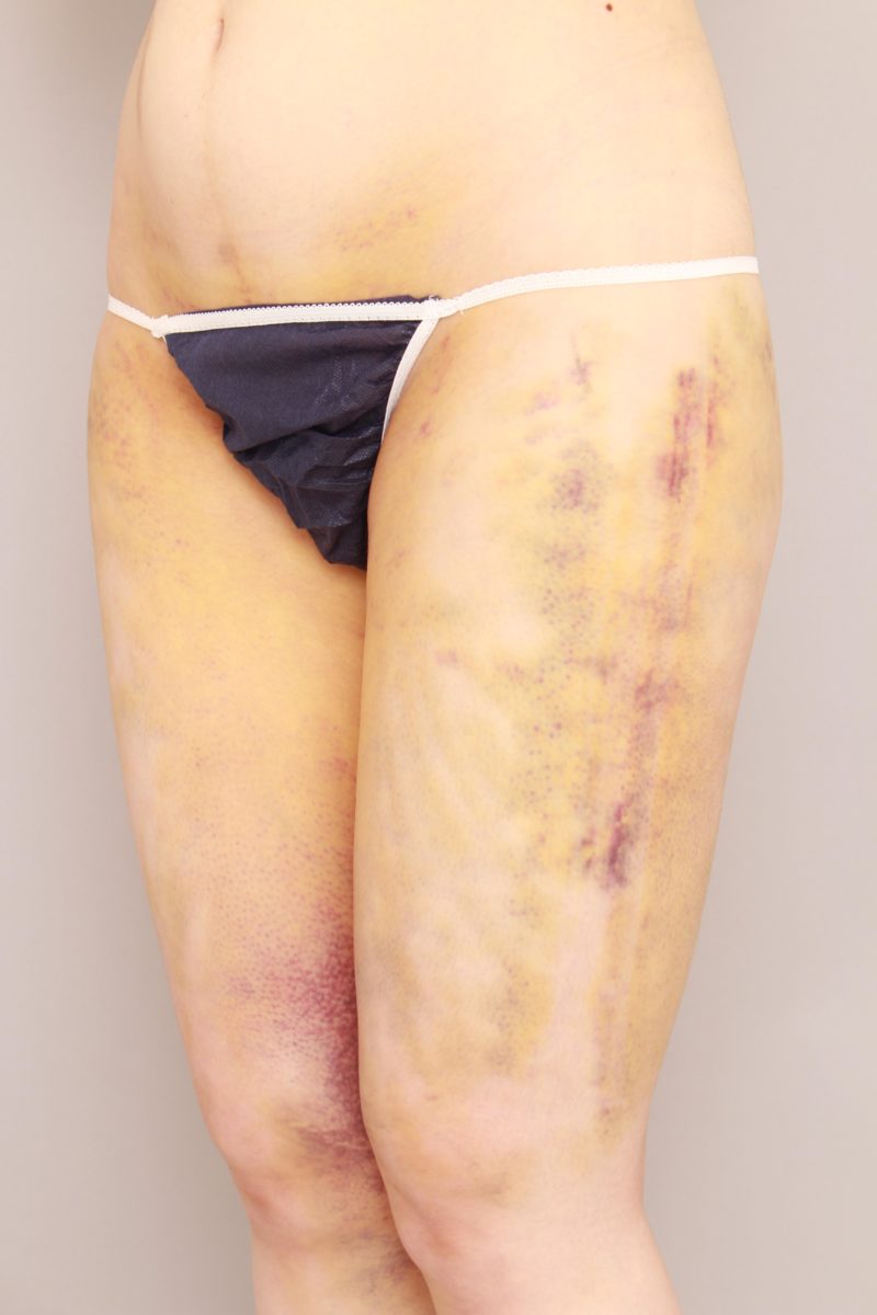 太もも全周、おしりの脂肪吸引の1週間後