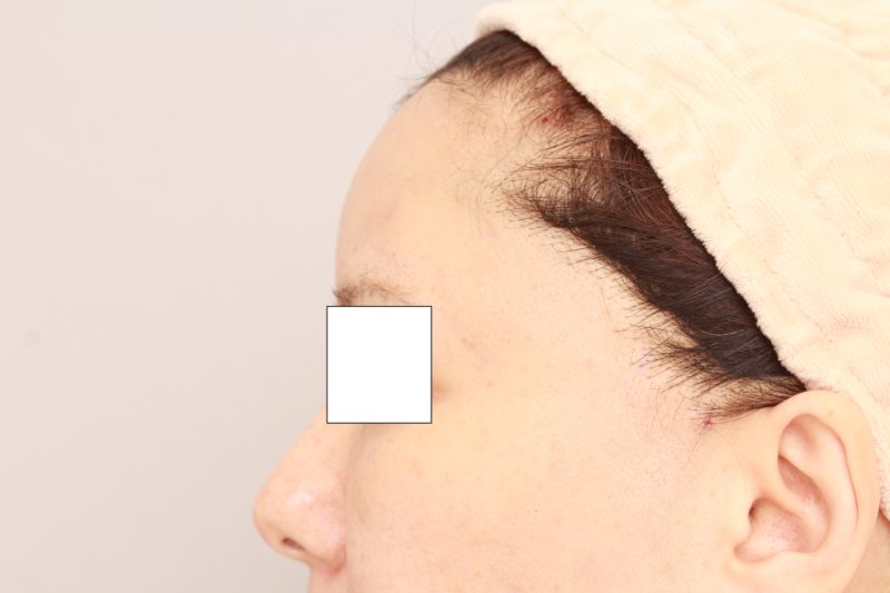 脂肪注入によるエイジングケア