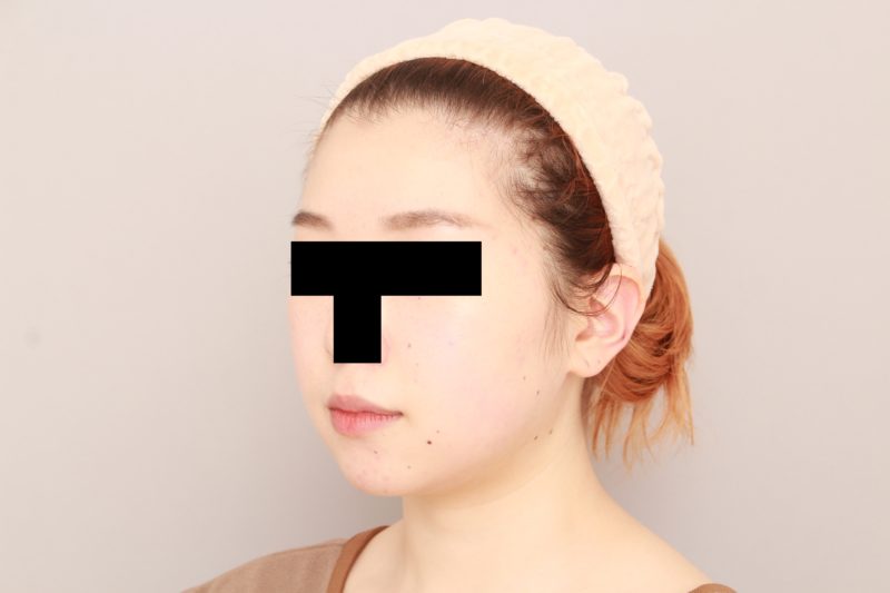 ほほ顎脂肪吸引でまっすます可愛らしい印象に