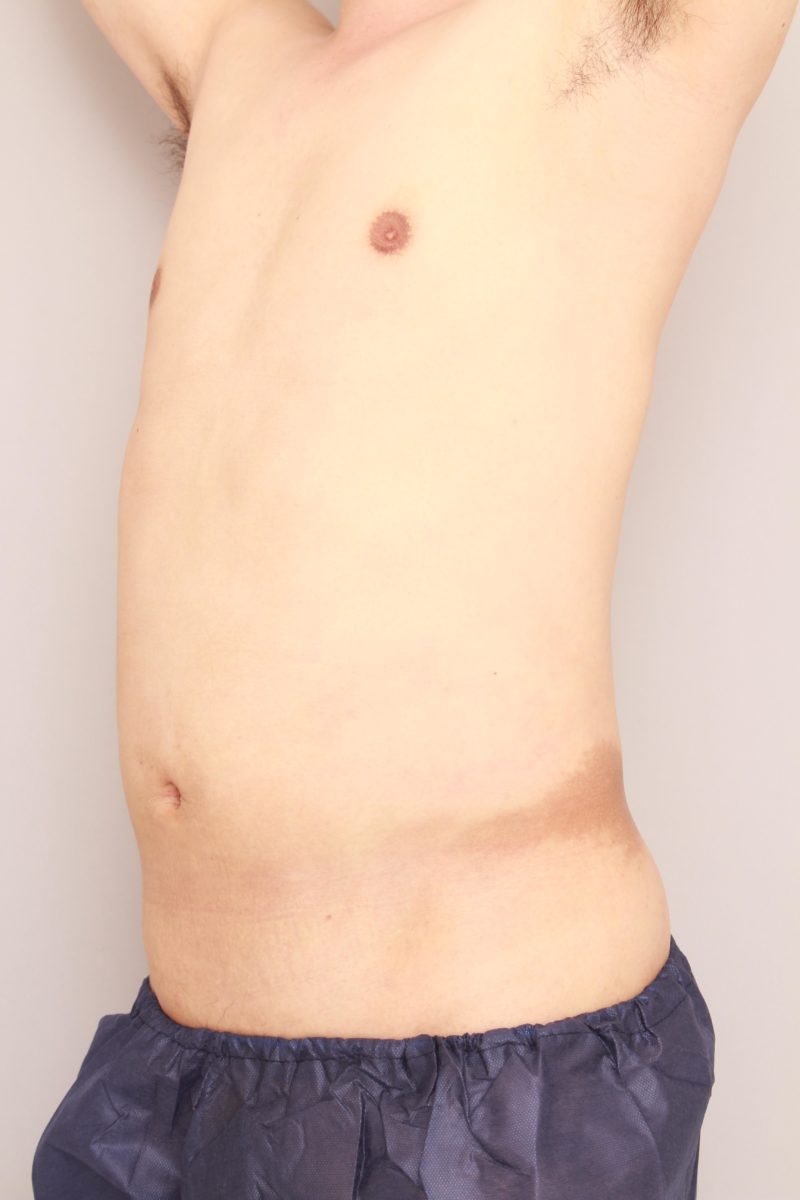 男性のお腹、腰の脂肪吸引1か月後