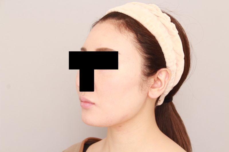 ほほ顎脂肪吸引でアンチエイジング