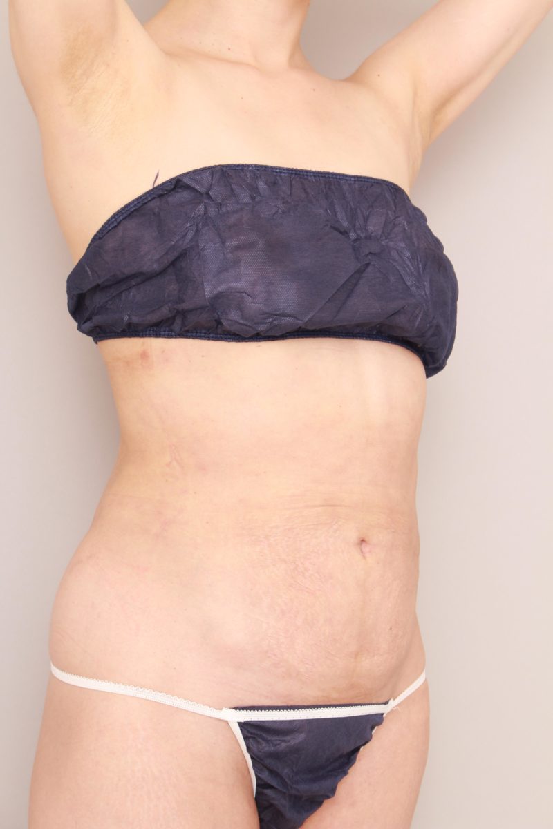 お腹腰の脂肪吸引1か月後の様子