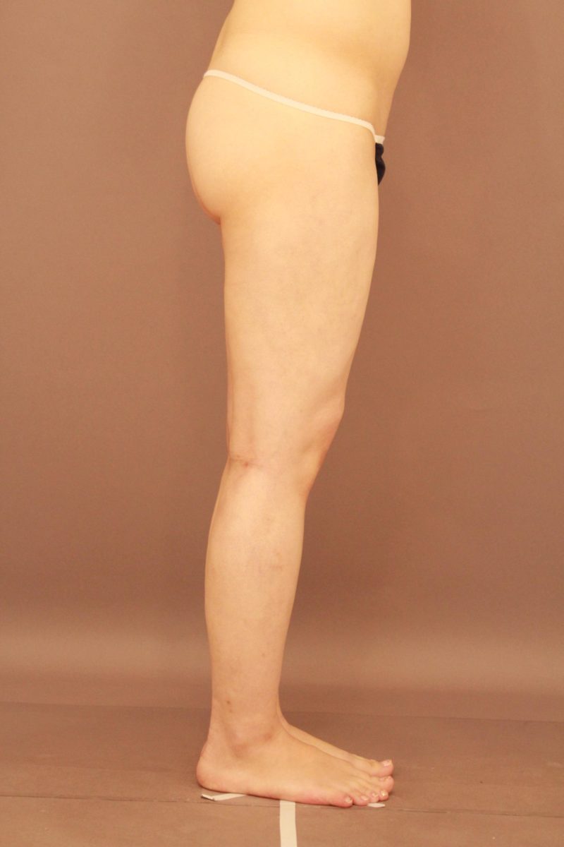 太もも全周、お尻の変化