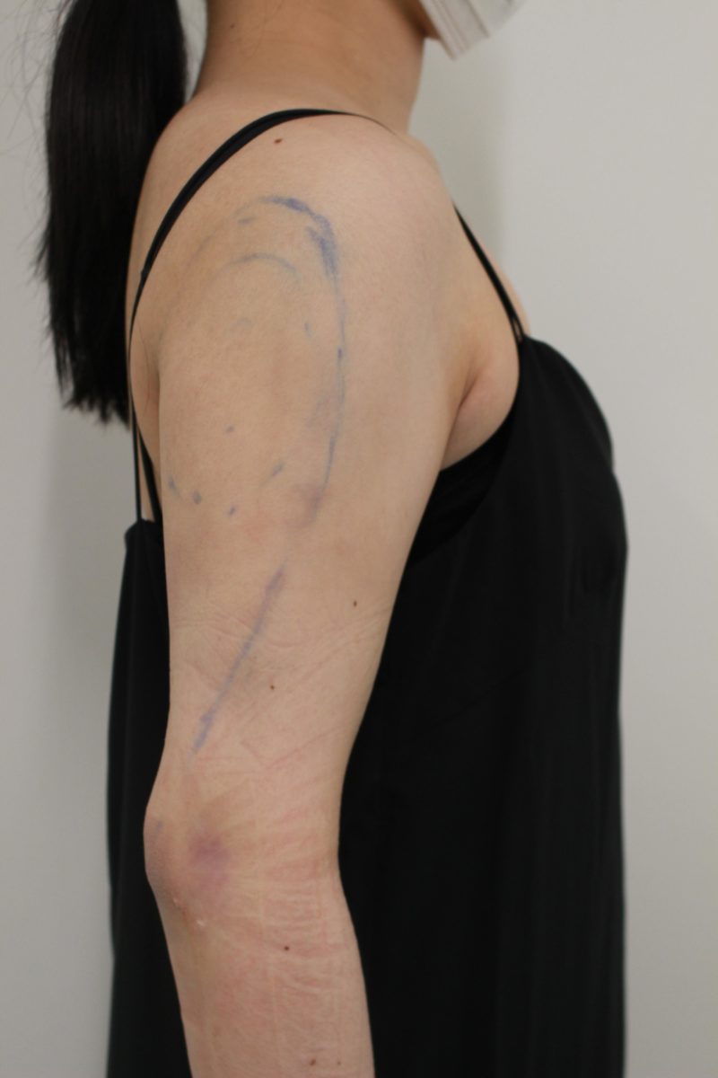 二の腕脂肪吸引の翌日