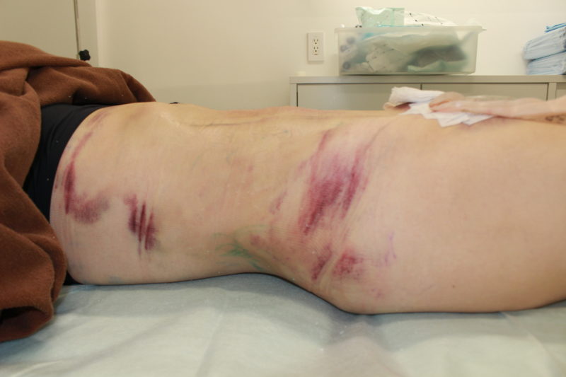 お腹、腰の脂肪吸引の翌日の様子