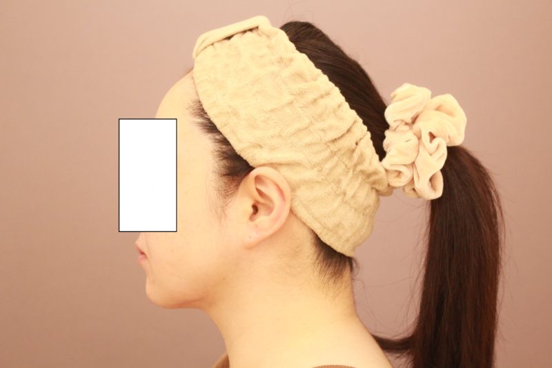 ほほ顎脂肪吸引