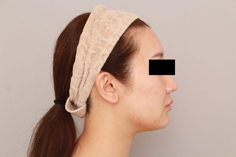 ほほ顎脂肪吸引の経過