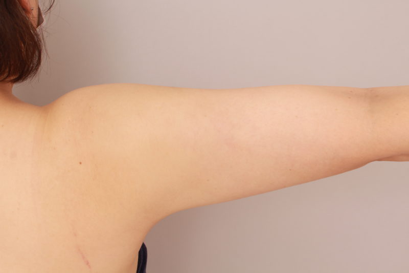 二の腕、肩の1か月後(たくさん吸引した方)