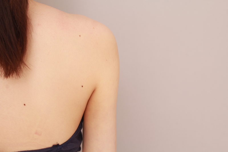 二の腕、肩の脂肪吸引1か月後