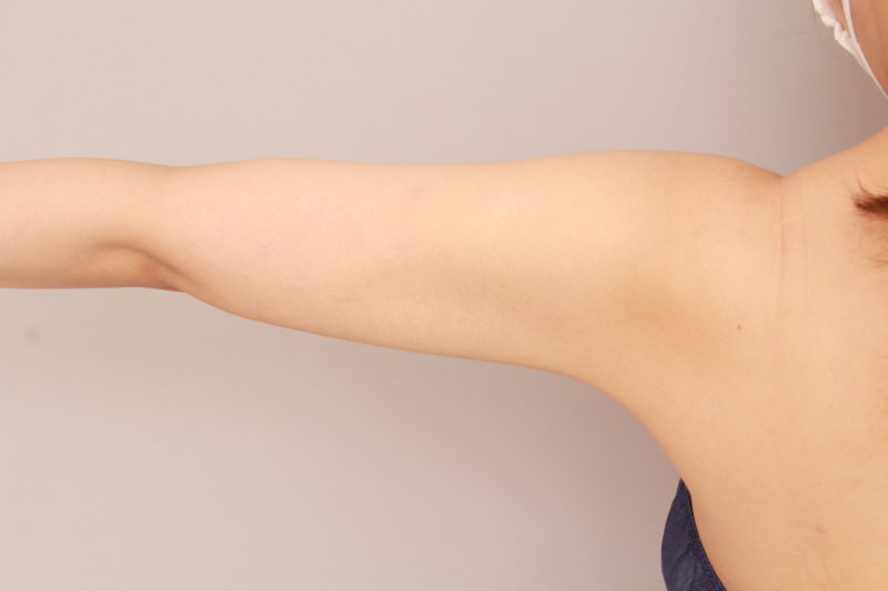 二の腕、肩のモニター様1か月後
