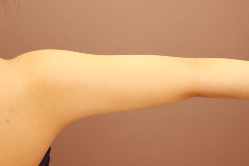 二の腕肩脂肪吸引の3か月後