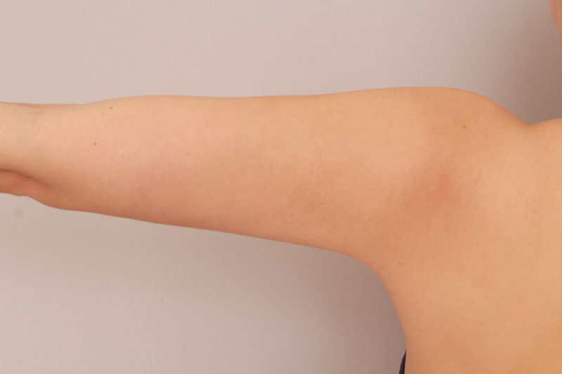 二の腕、肩の脂肪吸引1か月後