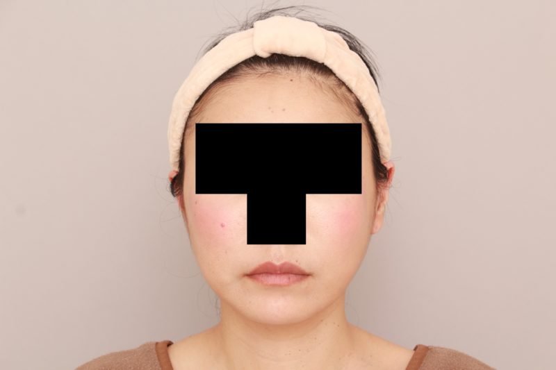 ほほ顎脂肪吸引1か月後