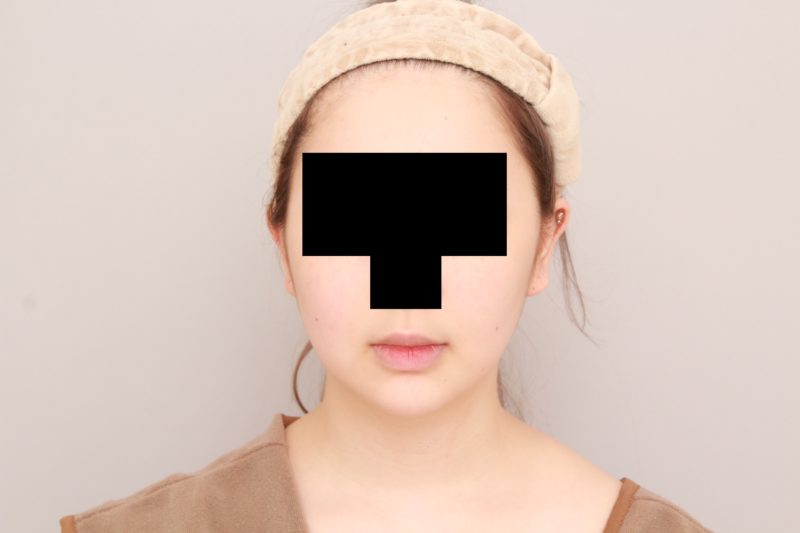 ほほ顎脂肪吸引モニター様1か月後