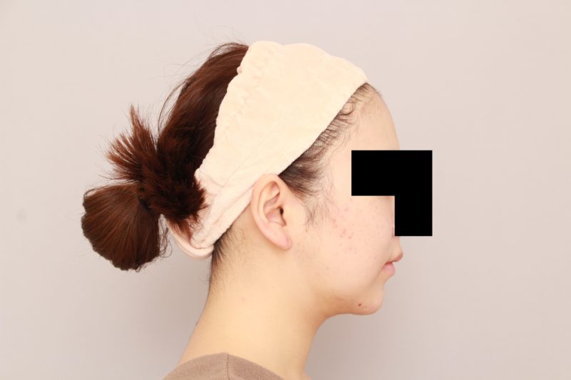 ほほ顎脂肪吸引1か月後