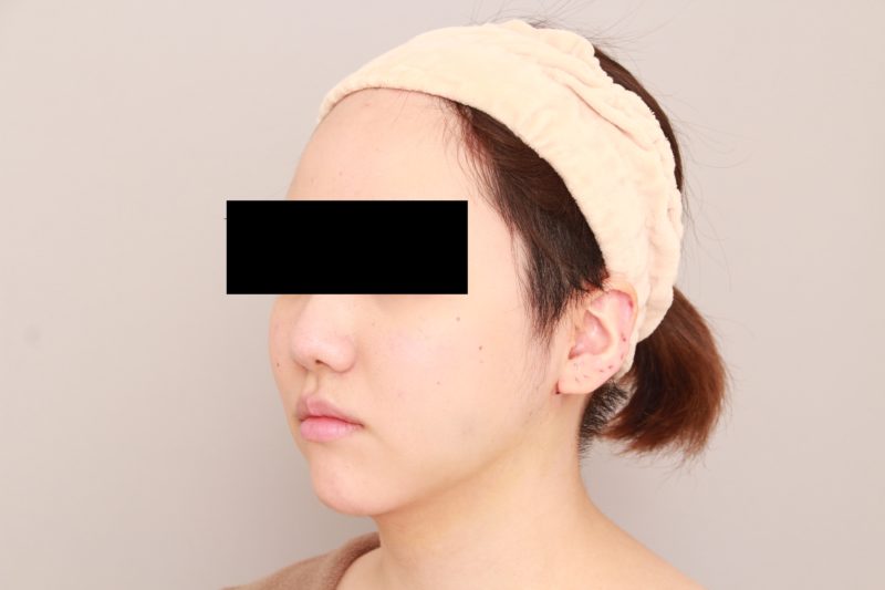 ほほ顎脂肪吸引の翌日の様子