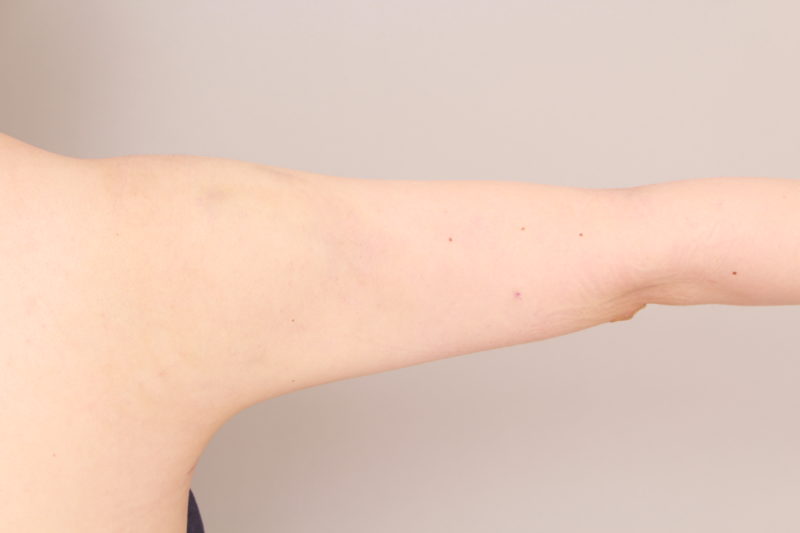 二の腕、肩の脂肪吸引の翌日の様子