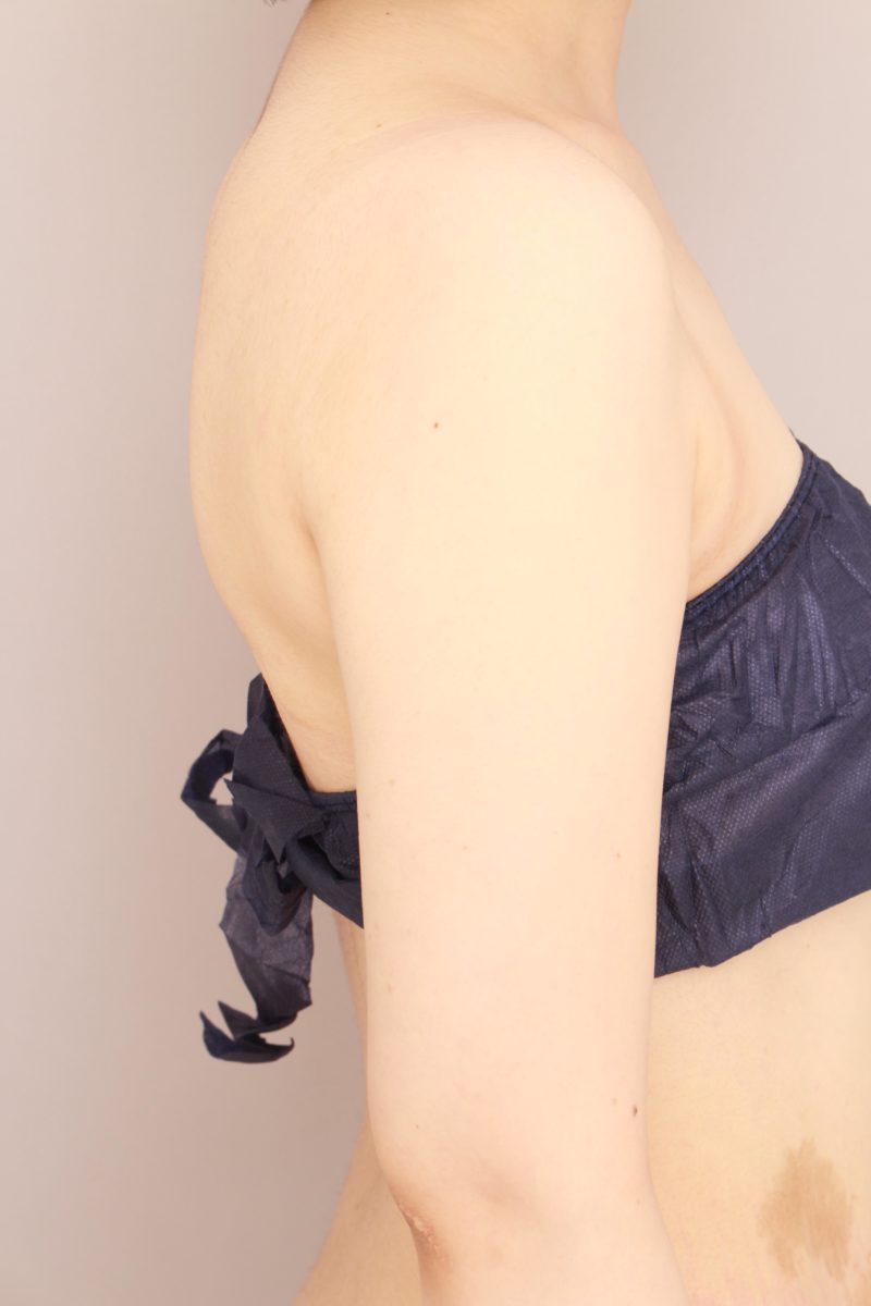 二の腕、肩の脂肪吸引1か月後