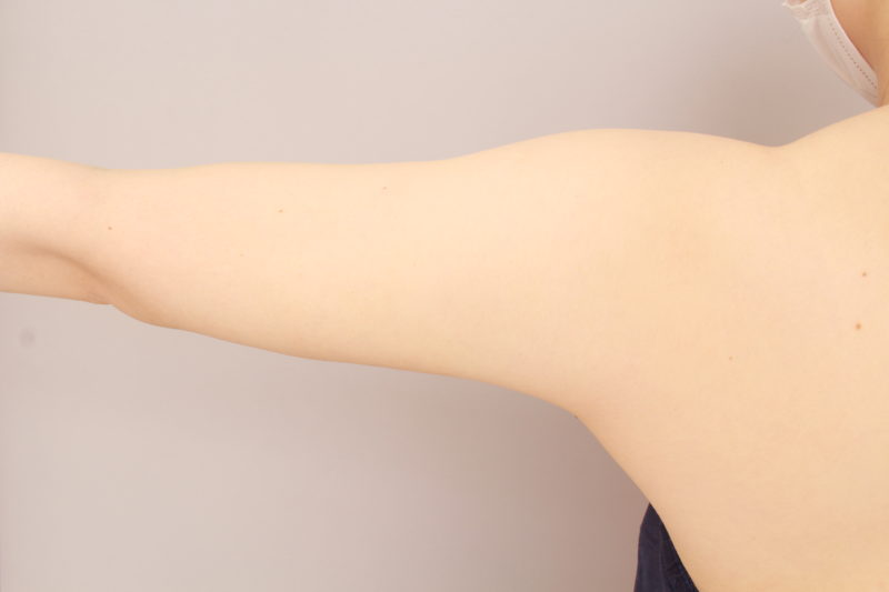 二の腕、肩の脂肪吸引1か月後