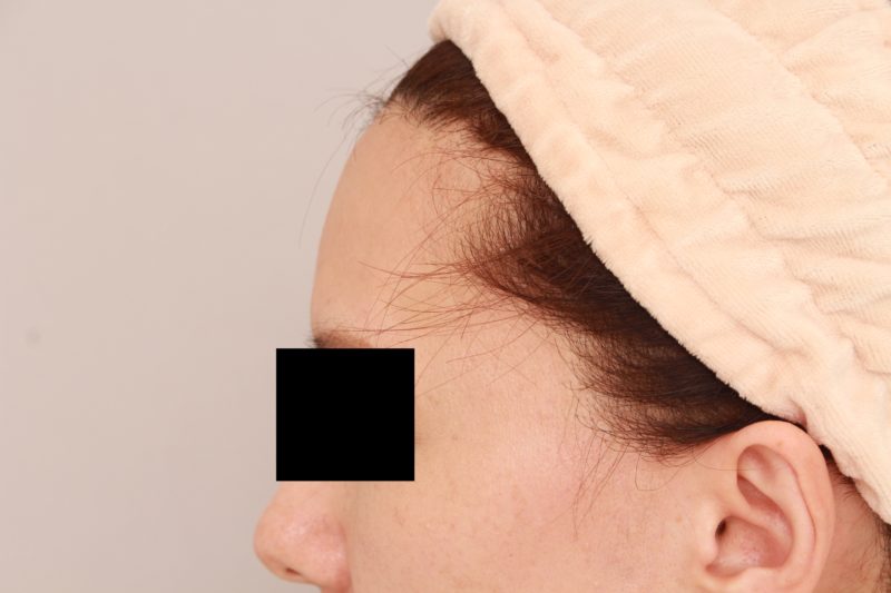 おでこ、こめかみの脂肪注入について