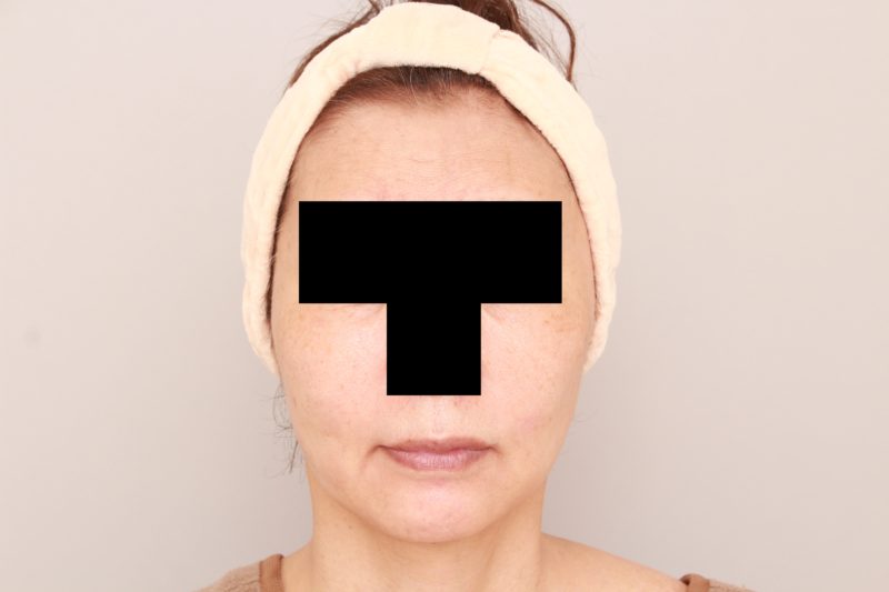 若返り施術の1か月後