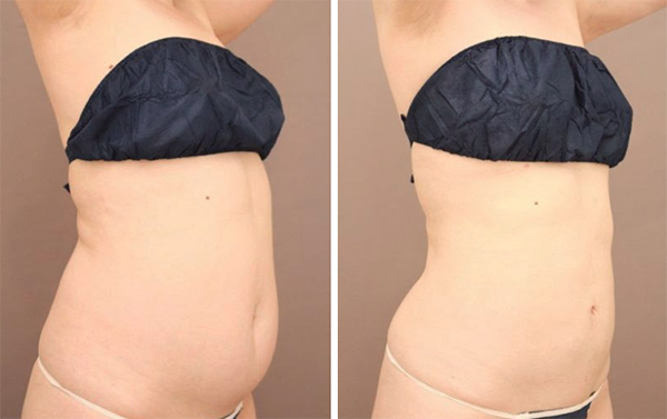 ベイザー脂肪吸引（腹部全体+胸下+腰）【女性［45歳］6ヶ月後】の症例写真