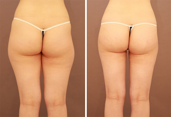 ベイザー脂肪吸引（大腿全周）【女性［27歳］1ヵ月後】の症例写真