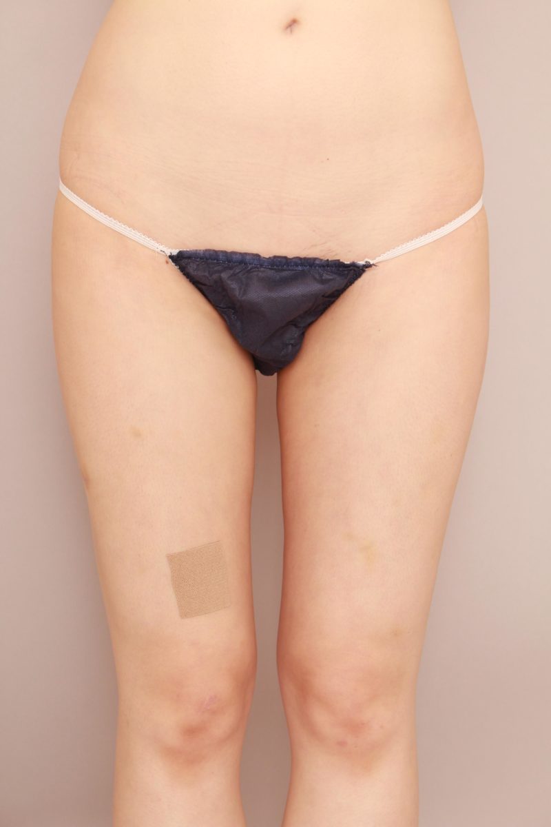 太もも全周、お尻の脂肪吸引のモニター様1か月後