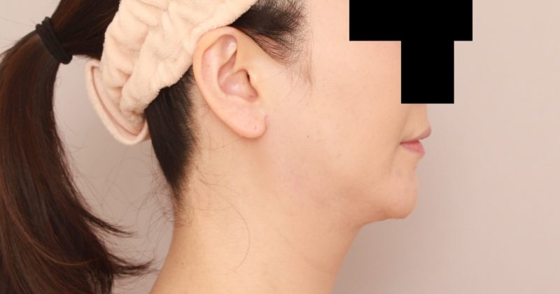 ほほ顎脂肪吸引1か月後