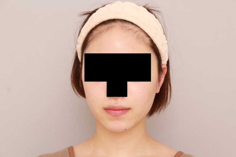 ほほ顎脂肪吸引の1か月後