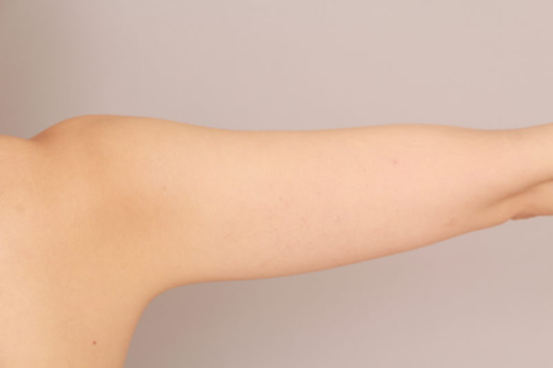 もともと痩せている方の二の腕、肩脂肪吸引