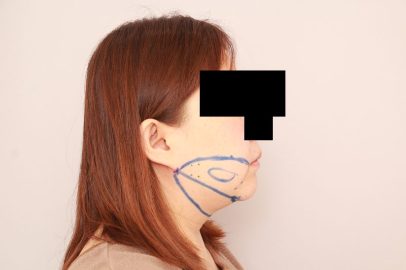 ほほ顎脂肪吸引のポイント